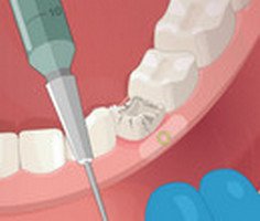 Play Dental Implant