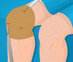 Knee Surgery